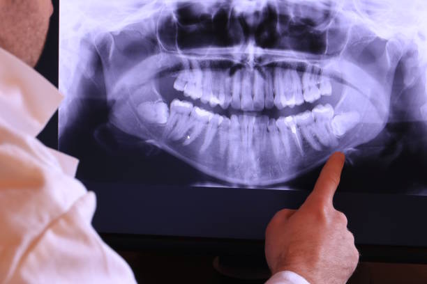 Best Emergency Wisdom Teeth Removal in Moorhead, MS