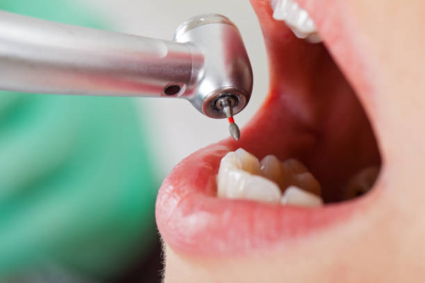 Best Emergency Tooth Extraction in Moorhead, MS